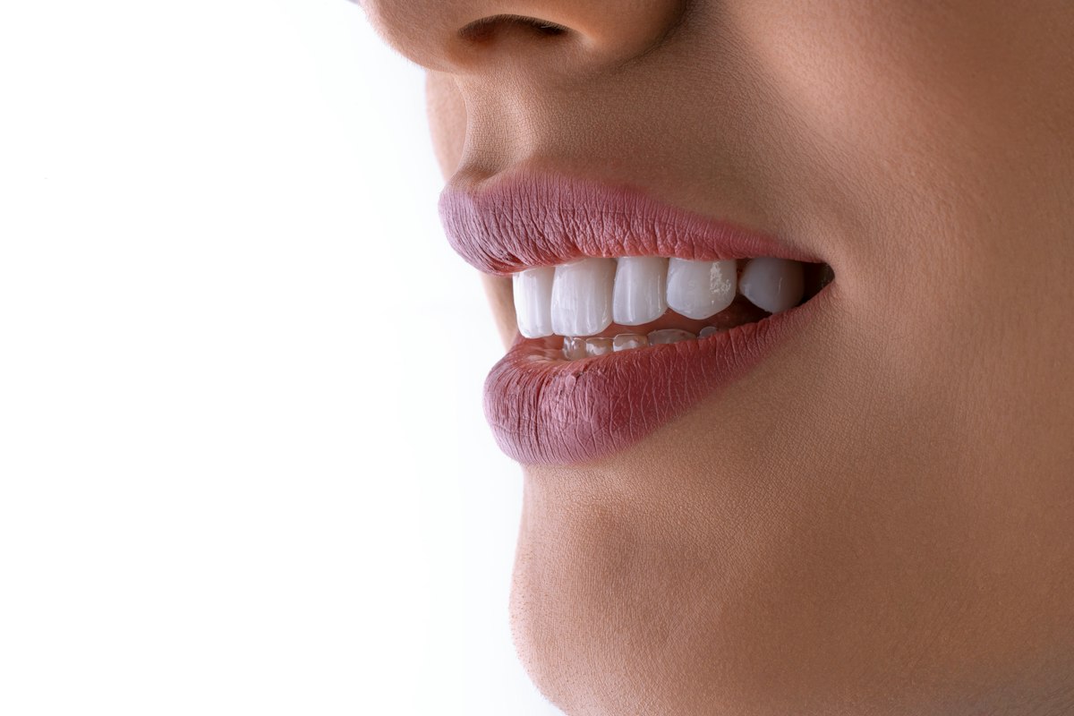 Blanqueamiento dental